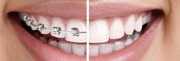 Free orthodontic consultation
