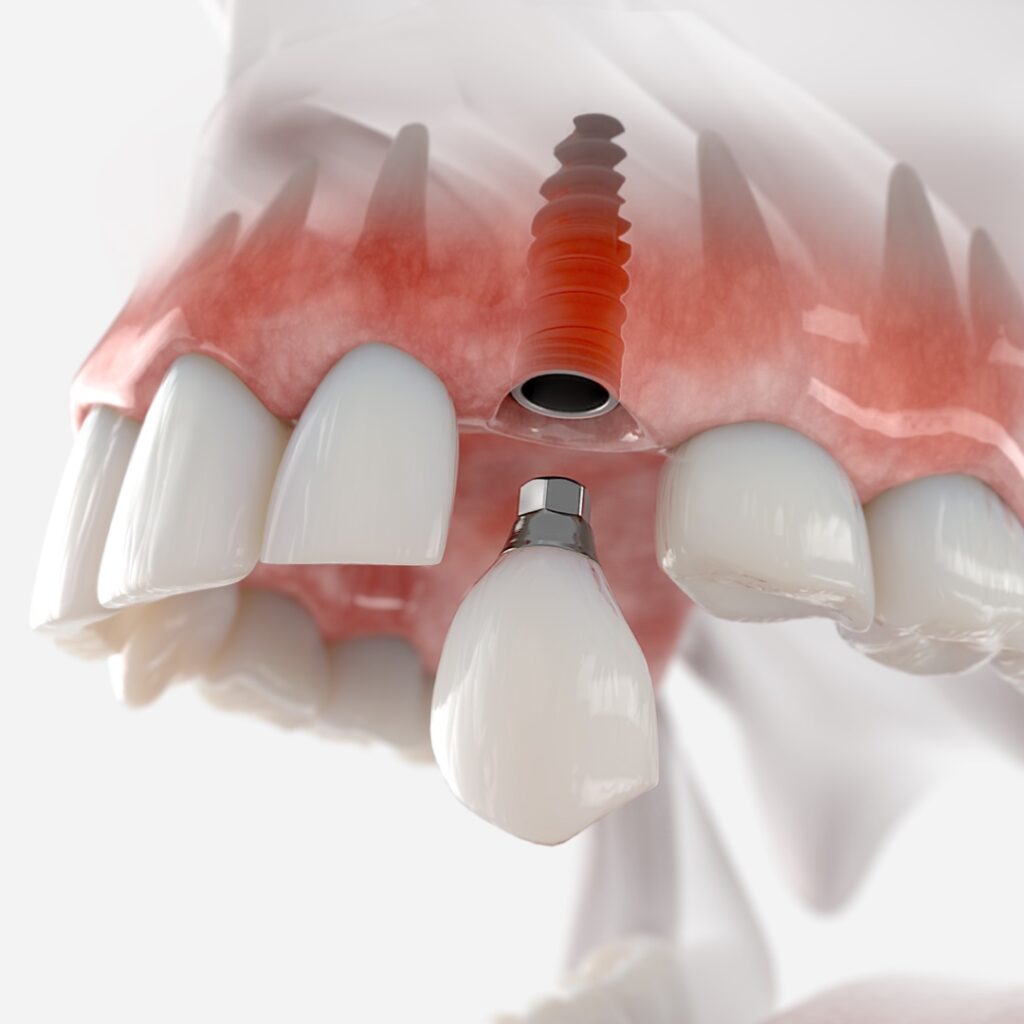 Implants Rathgar Dental