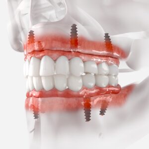 The power of dental implants x Rathgar Dental