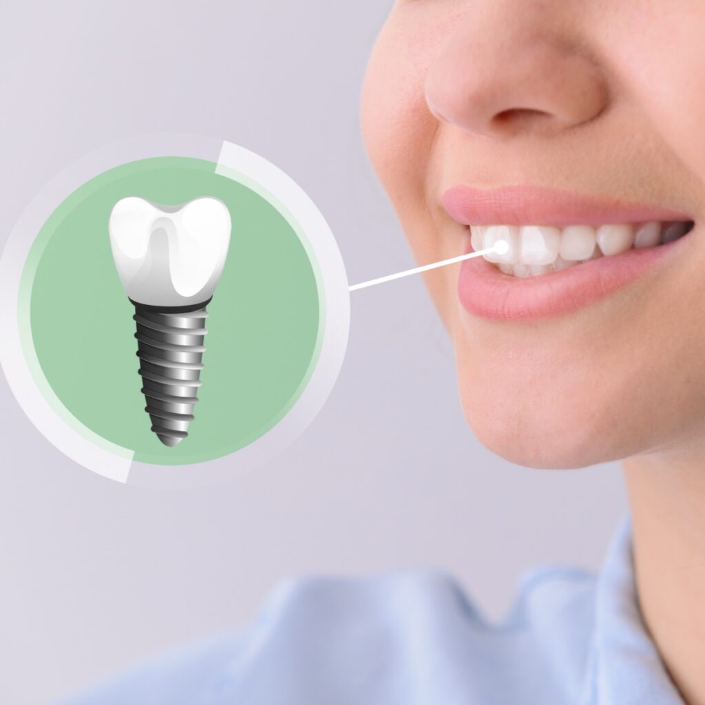 €150 OFF your first dental implant Rathgar Dental €150 OFF your first dental implant Rathgar Dental